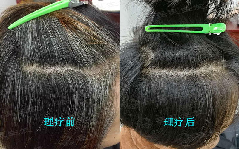 白頭發怎么才能轉黑