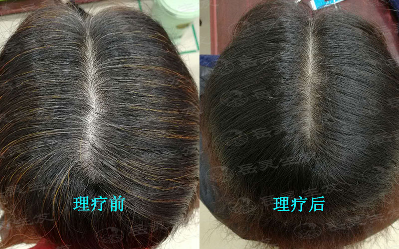 白發變黑發的養發方法其實很簡單