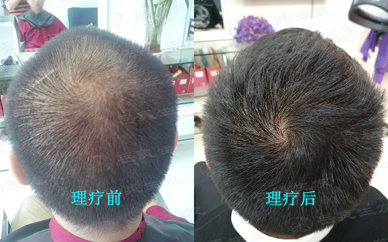 怎么防脫生發的養發護發辦法