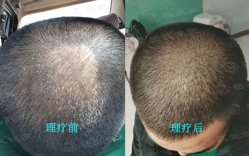 什么防脫生發養發方法能夠改善掉頭發