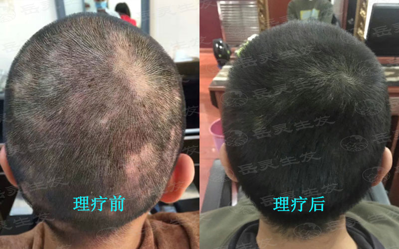 防脫生發男女有不同的生發養發方法