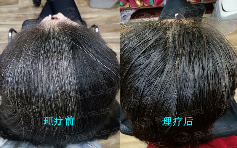 缺什么營養會導致白發?應該如何養發?