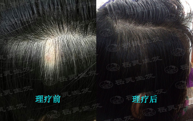 有哪些引起脫發的原因?