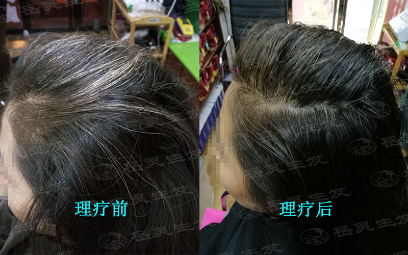 少白頭是早衰嗎?如何養發能變黑?