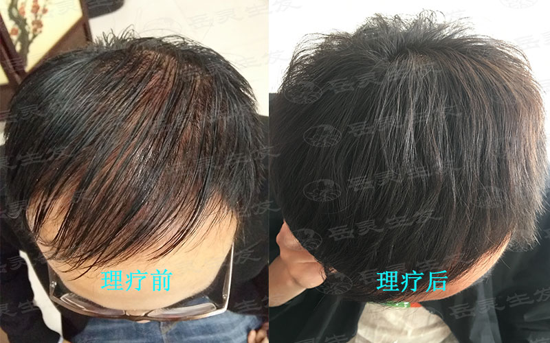脫頭發是什么原因所致?如何養發能夠防脫發?