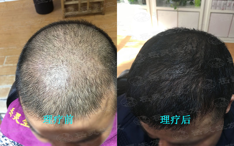 經常熬夜失眠會不會導致脫發?應該如何養發?