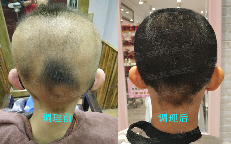 各類脫發癥狀情況該如何養發改善?
