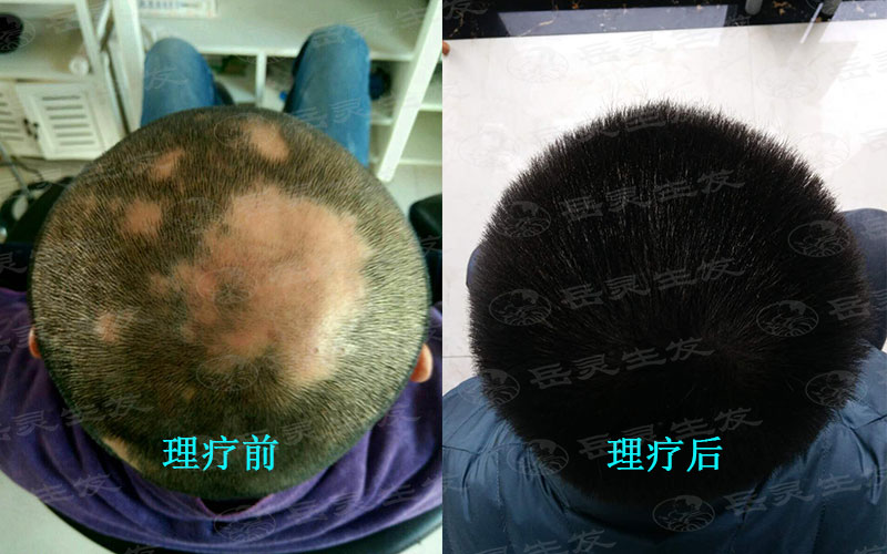吃什么養發護發有利于防脫生發