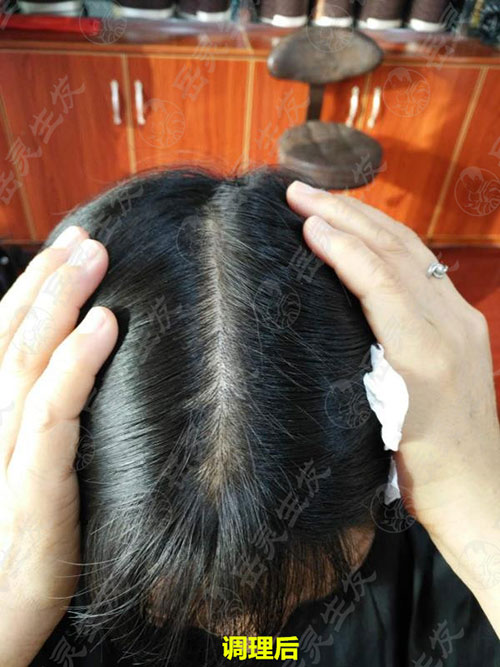 白發轉黑調理后