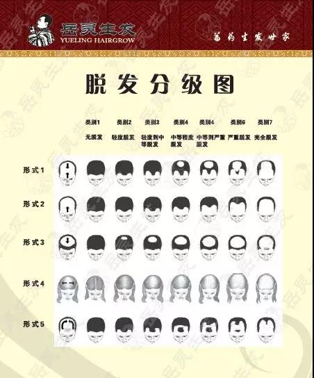 脫發分級圖