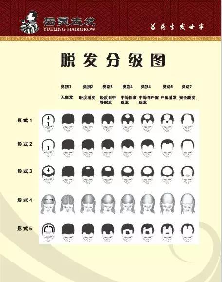 脫發分級圖