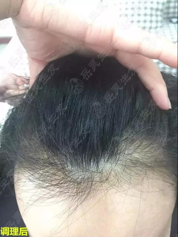 岳靈生發白發調理后