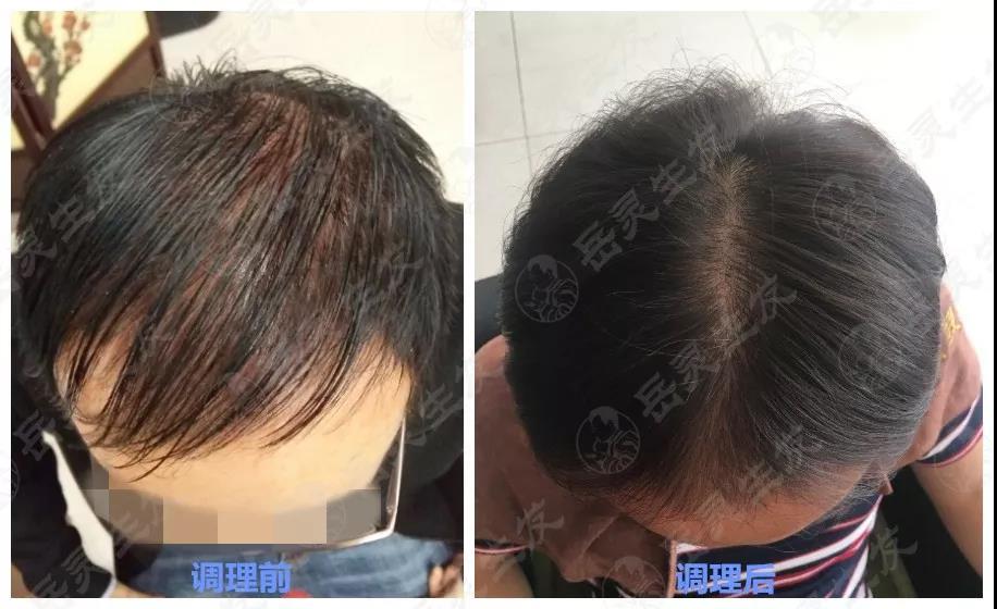脫發恢復實例