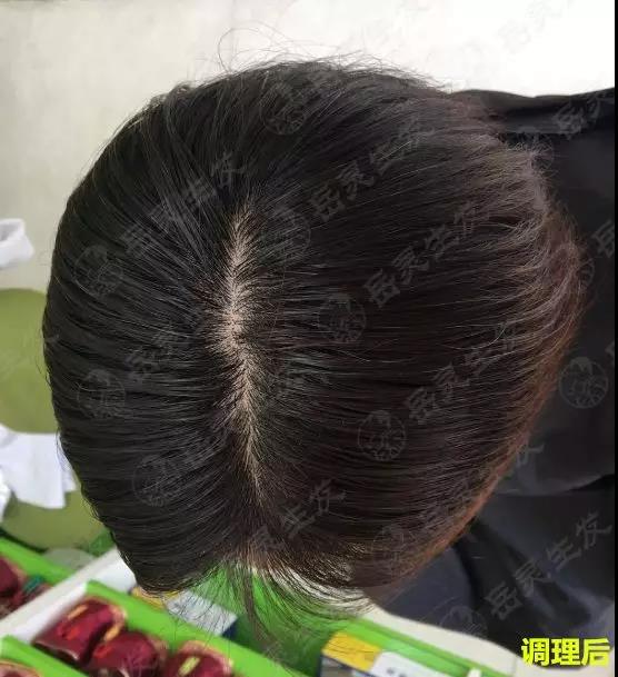 岳靈生發調理后