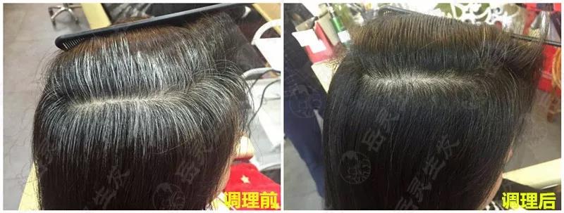 岳靈生發白發轉黑實例