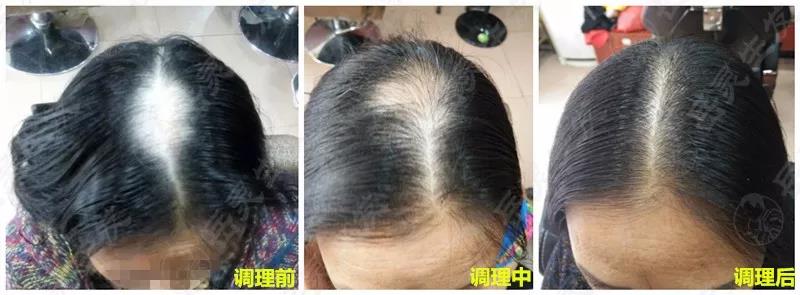 岳靈生發(fā)斑禿恢復(fù)實(shí)例