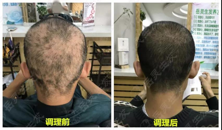 岳靈生發遼寧沈陽店斑禿恢復實例