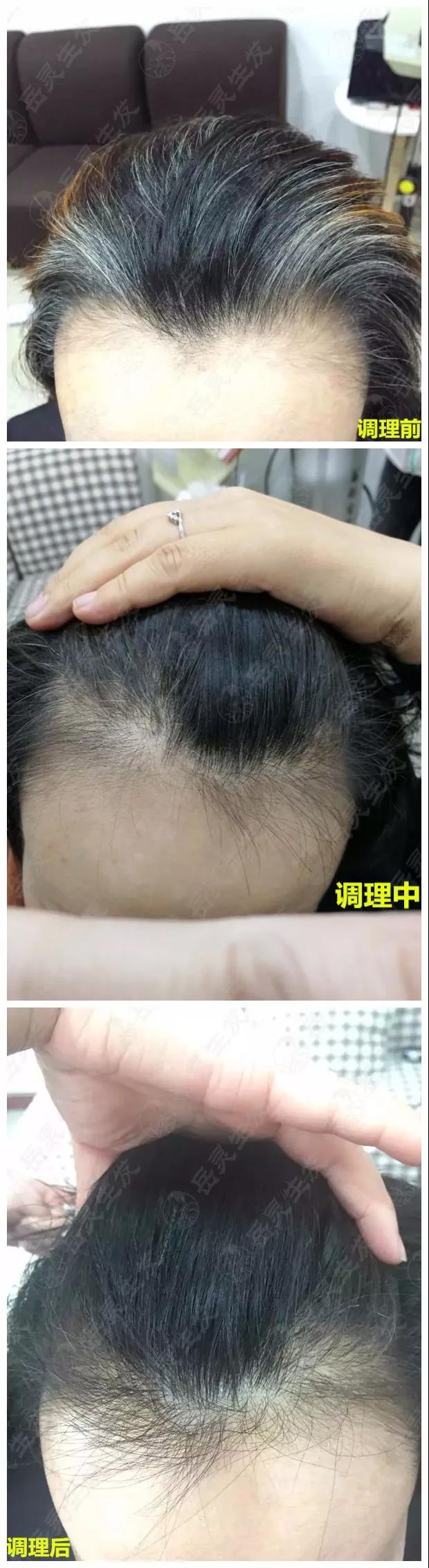 岳靈生發白發轉黑實例