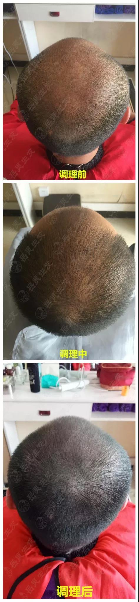 岳靈生發脫發再生實例