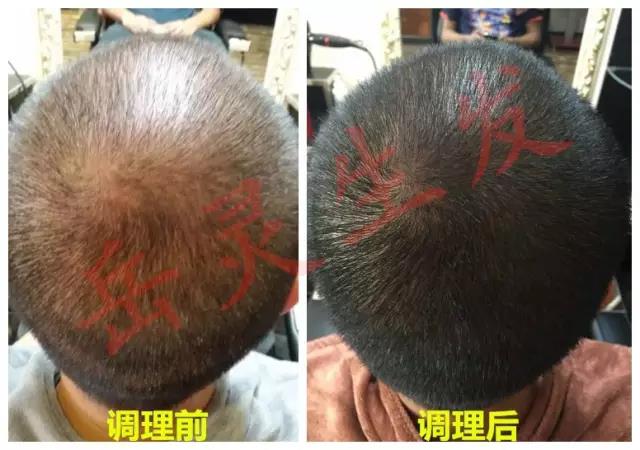 岳靈生發新疆第15店脫發恢復實例