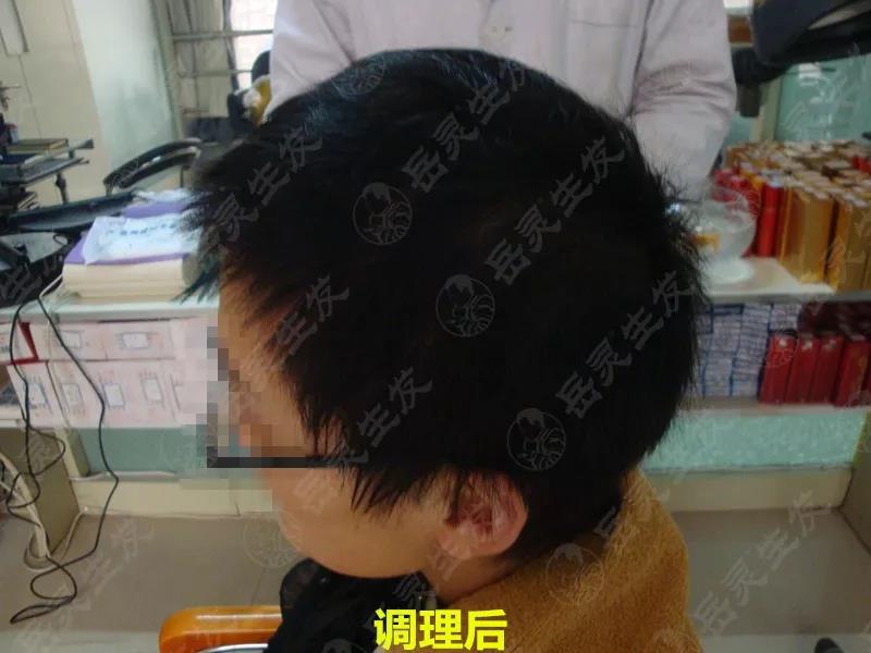 岳靈生發女性脫發調理后
