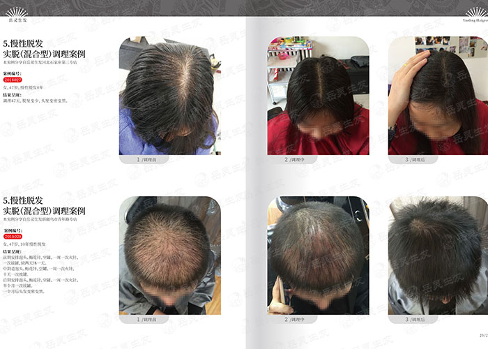 岳靈生發為您解析一年四季都在脫發掉發的原因