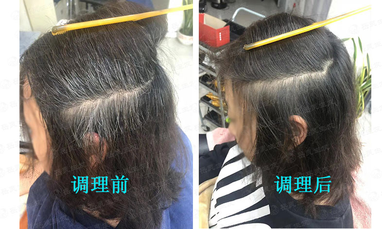 岳靈告訴你鬢角有白發的原因和如何去養發調理