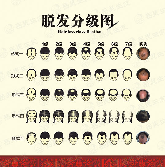 中年脫發的原因和防脫發保健措施
