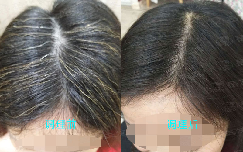 忽然長白發是什么原因造成的