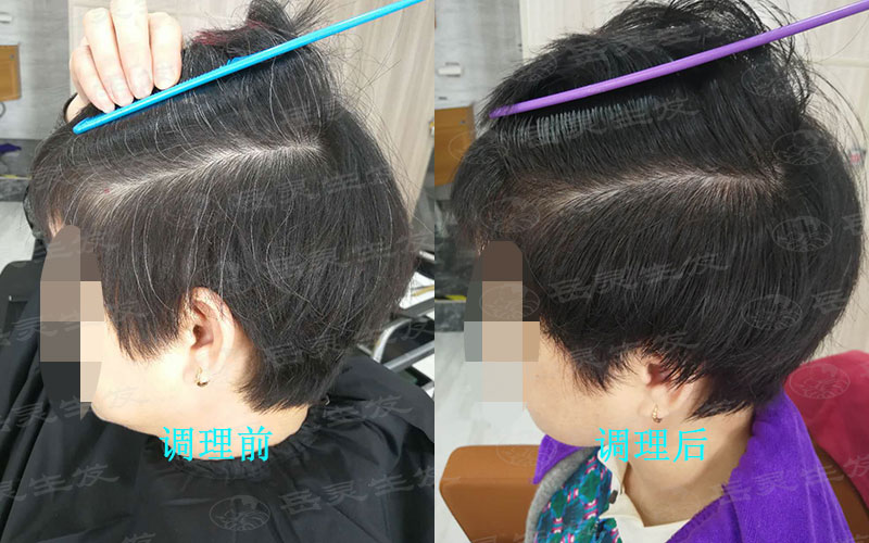 什么生發方法可以調理白發？