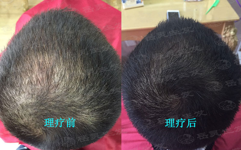 如何預防脫發才能比較好
