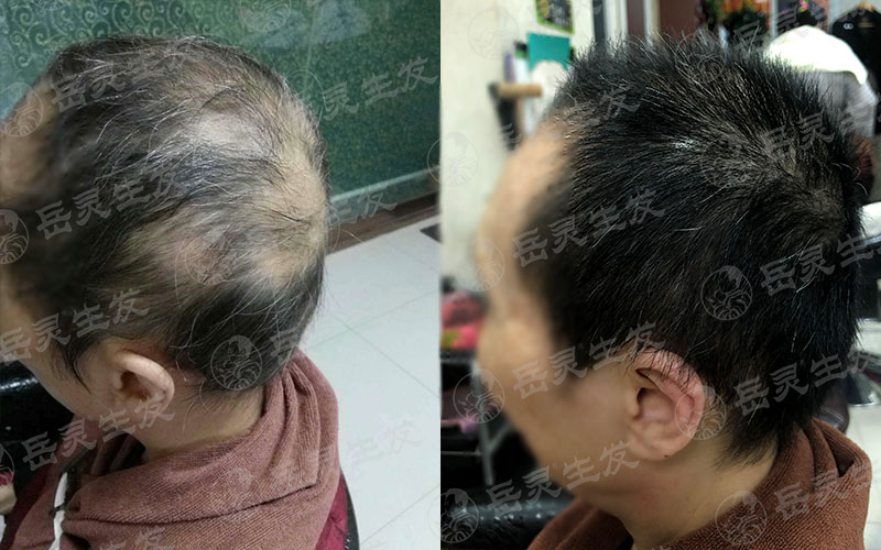 脫發皮痿癥
