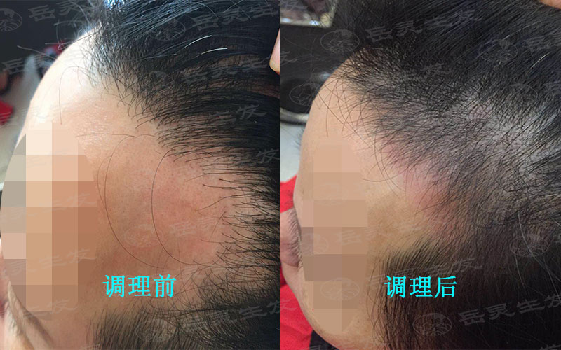 生發恢復難易辯證