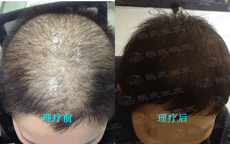 男性防脫育發擺脫“地中海”