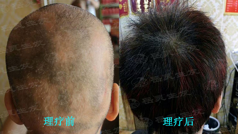 壓力大脫發怎么辦