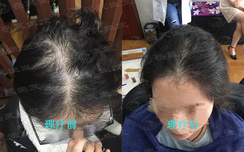 為什么女性脫發大多與月經婦科有關?