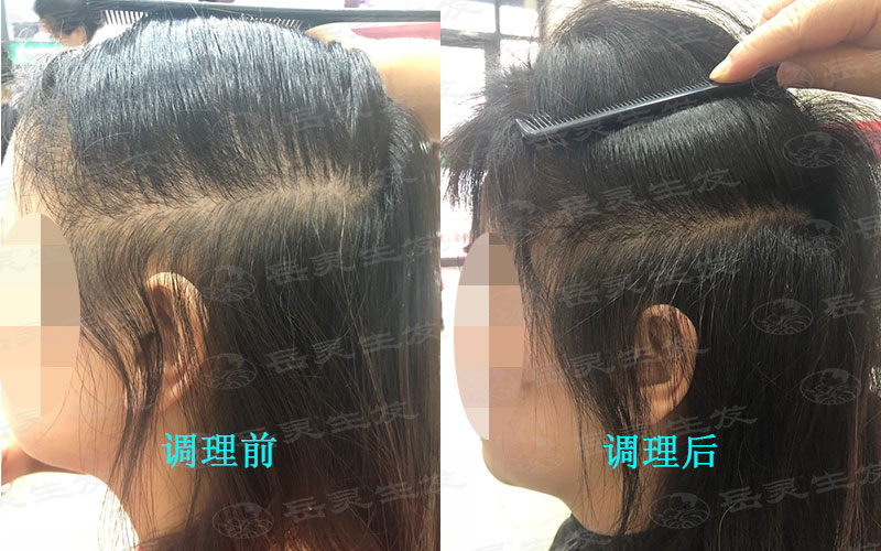 女性脫發該怎么養發改善?