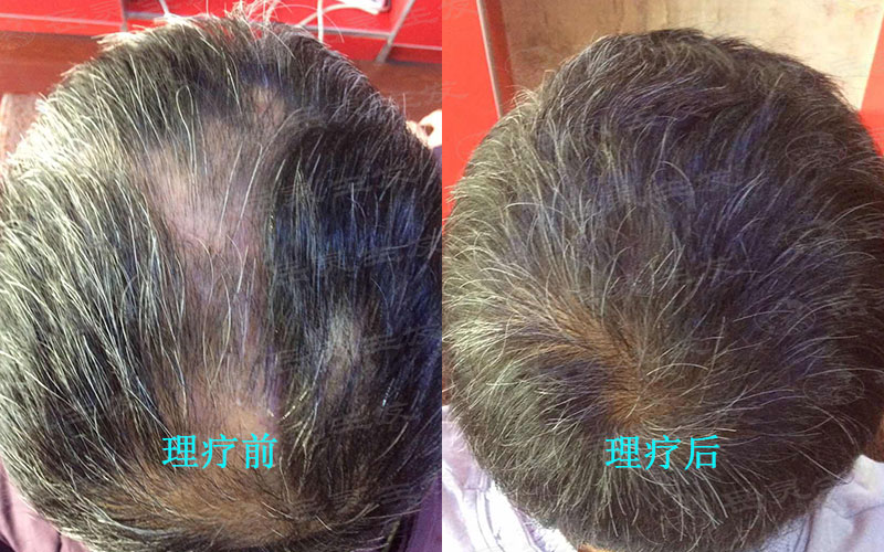 按摩頭皮防脫生發的好方法