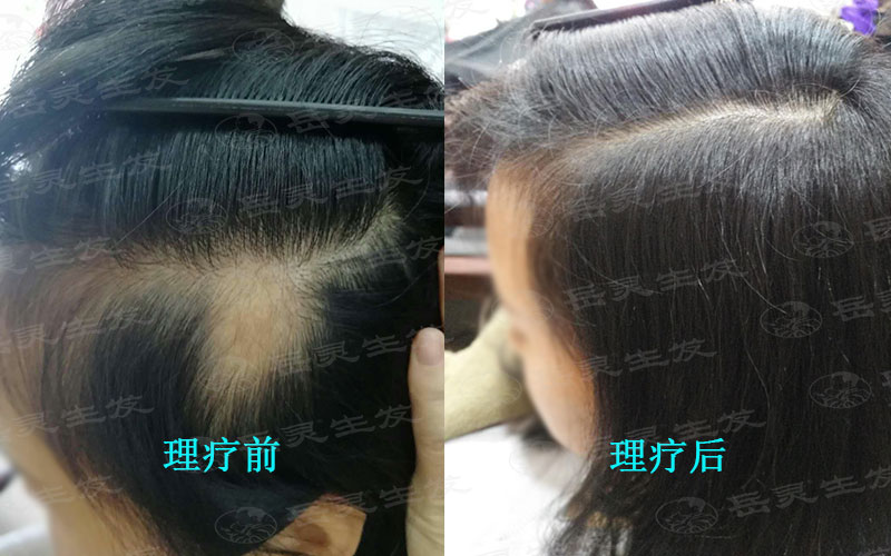 岳靈生發的產品為什么是特殊化妝品?能有療效嗎?