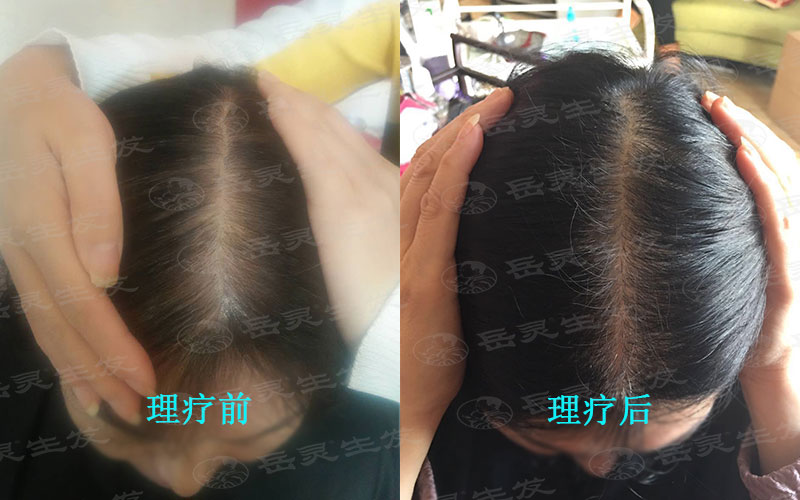 怎么止脫生發的養發護發好方法