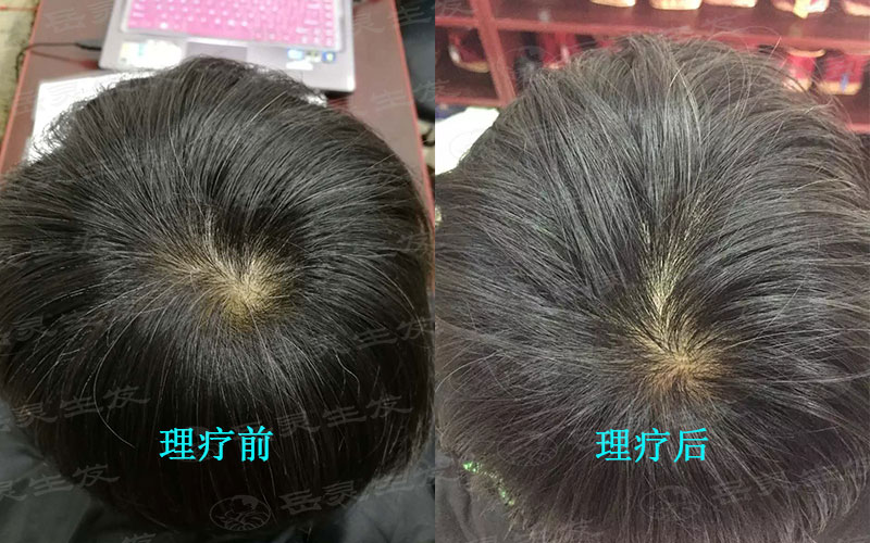 白發的病因有哪些?