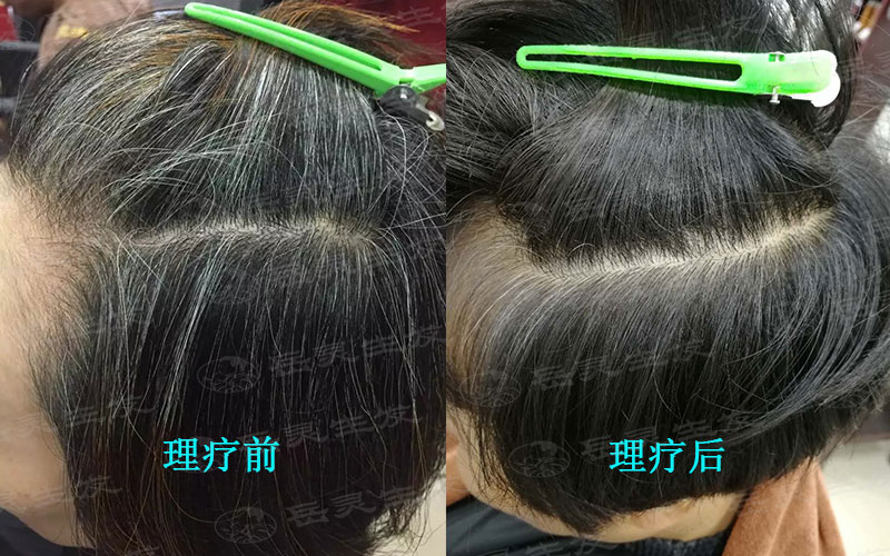 治療白發有年齡限制嗎?
