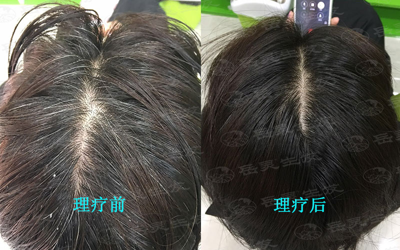 白發顧客需要敲火針,敲梅花針嗎?
