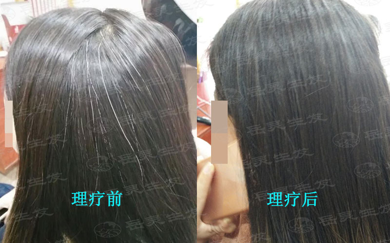 長白發的原因有哪些?