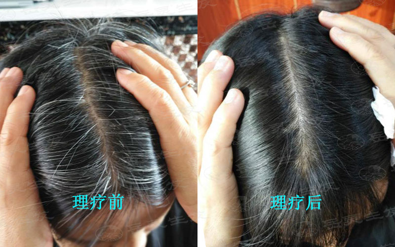 年輕人應該如何養發預防白發問題