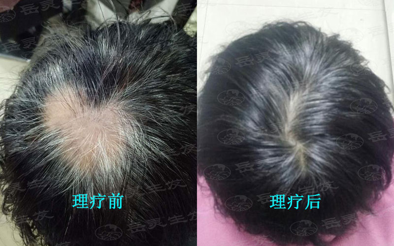 生活中防脫生發的養發小妙招