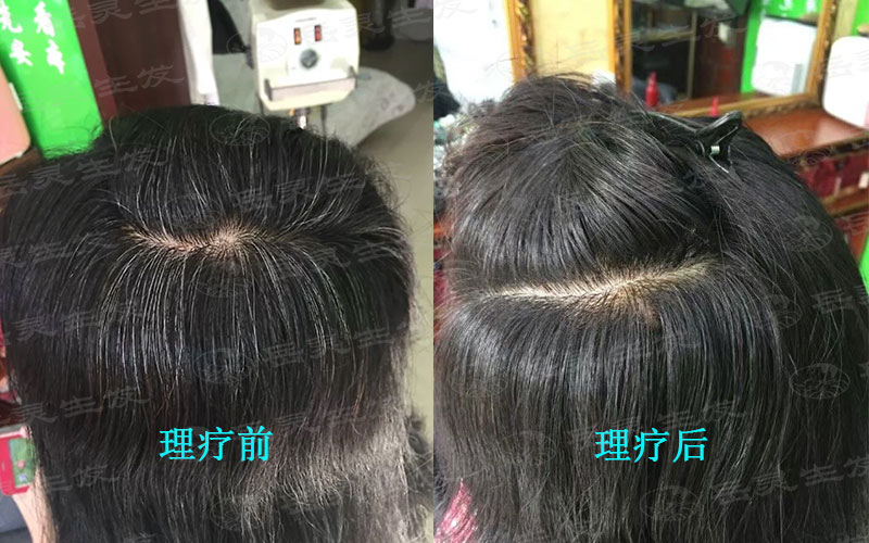 產后白發吃什么有利于轉黑?