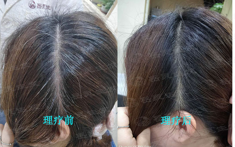 白發轉黑發