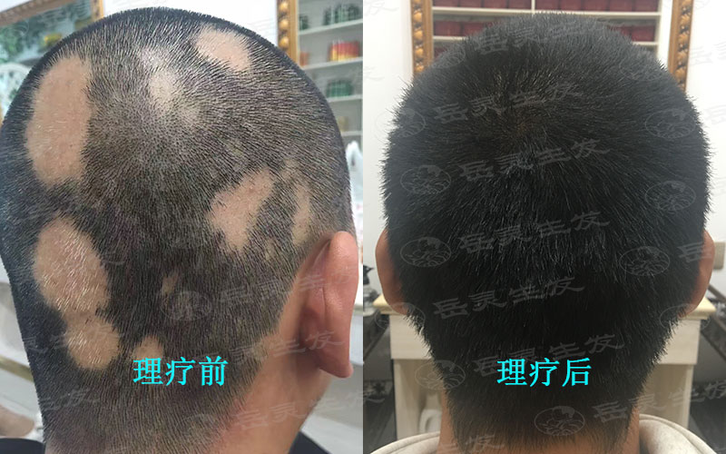 防脫生發案例